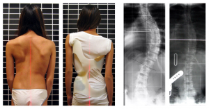 Proper Posture Correction Treatment in Downtown NY