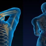 image of back and neck pain with radio frequency