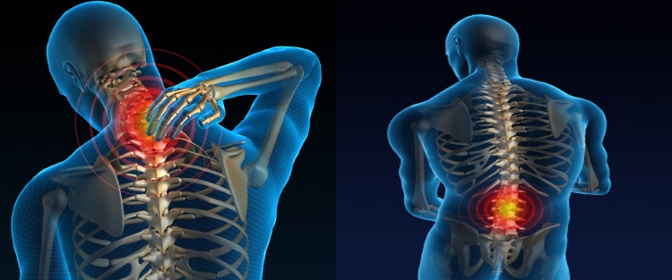 image of back and neck pain with radio frequency