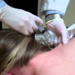 female patient receiving injection in the neck