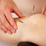 acupuncture needles pinned to a female's knee