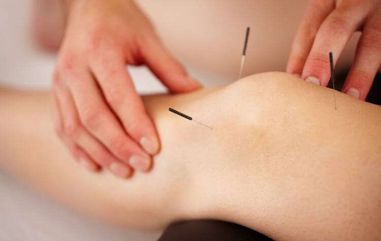 acupuncture needles pinned to a female's knee
