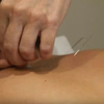 acupuncture therapy