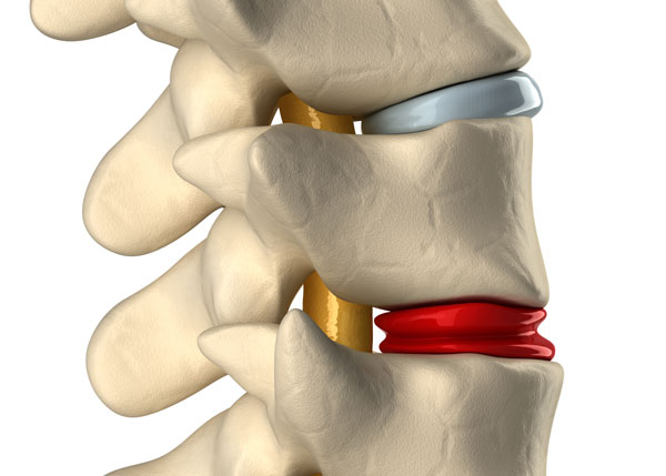 Sneezing Herniated Disc